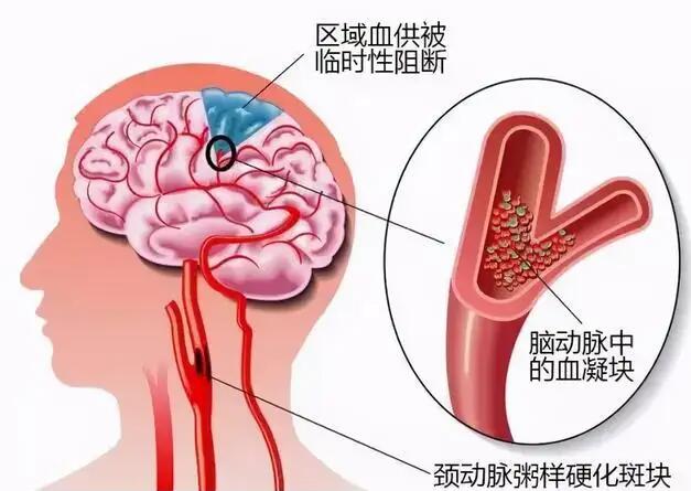 經(jīng)顱多普勒儀器廠家?guī)私饽X動(dòng)脈硬化的臨床表現(xiàn)